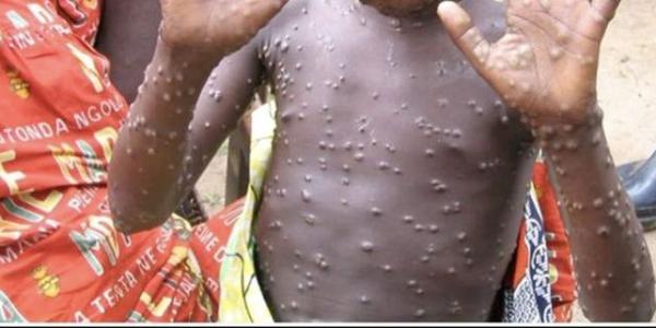 Un enfant atteint de la variole de siège 