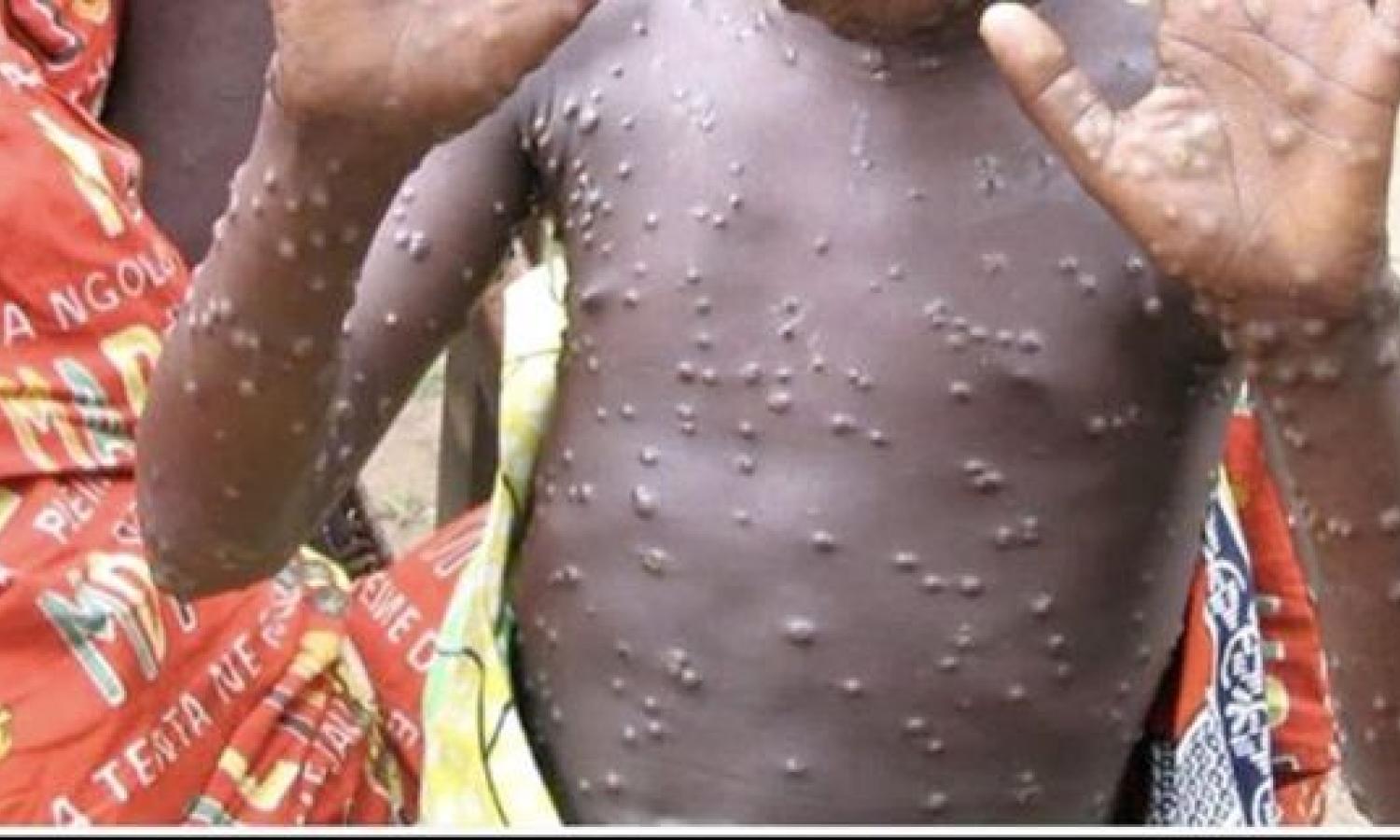 Un enfant atteint de la variole de siège 